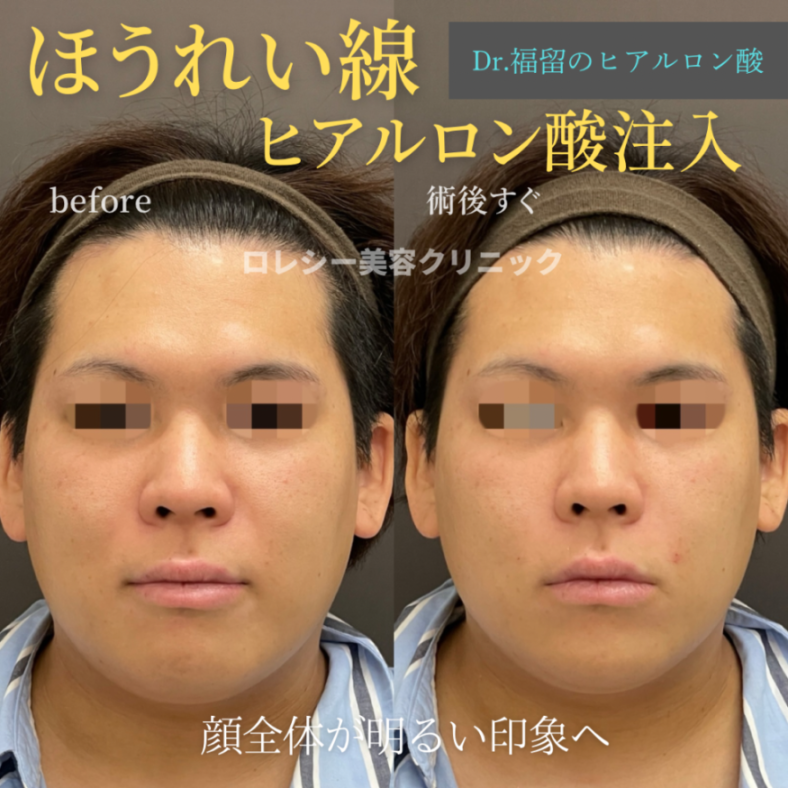 ほうれい線ヒアルロン酸症例写真