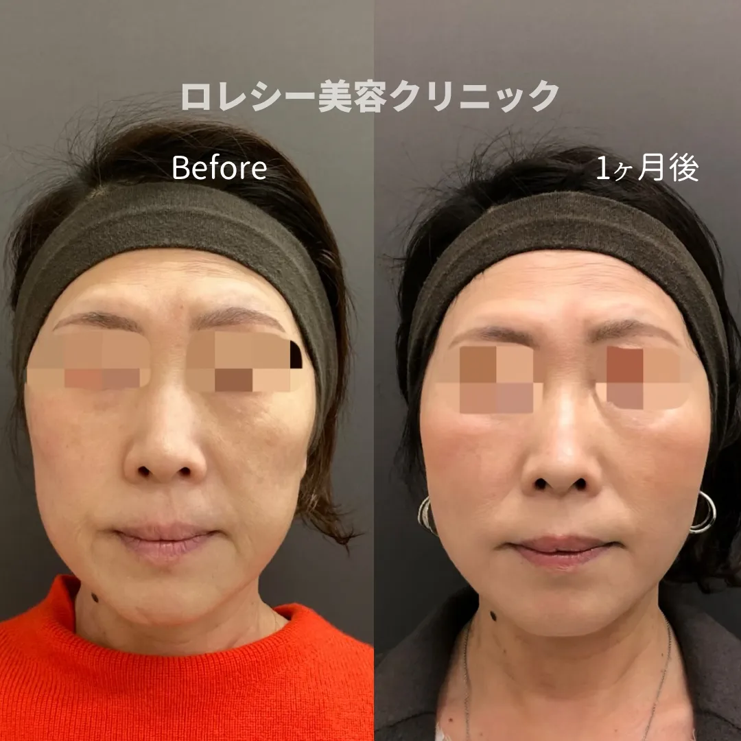 トゥインクルリフト12本症例写真