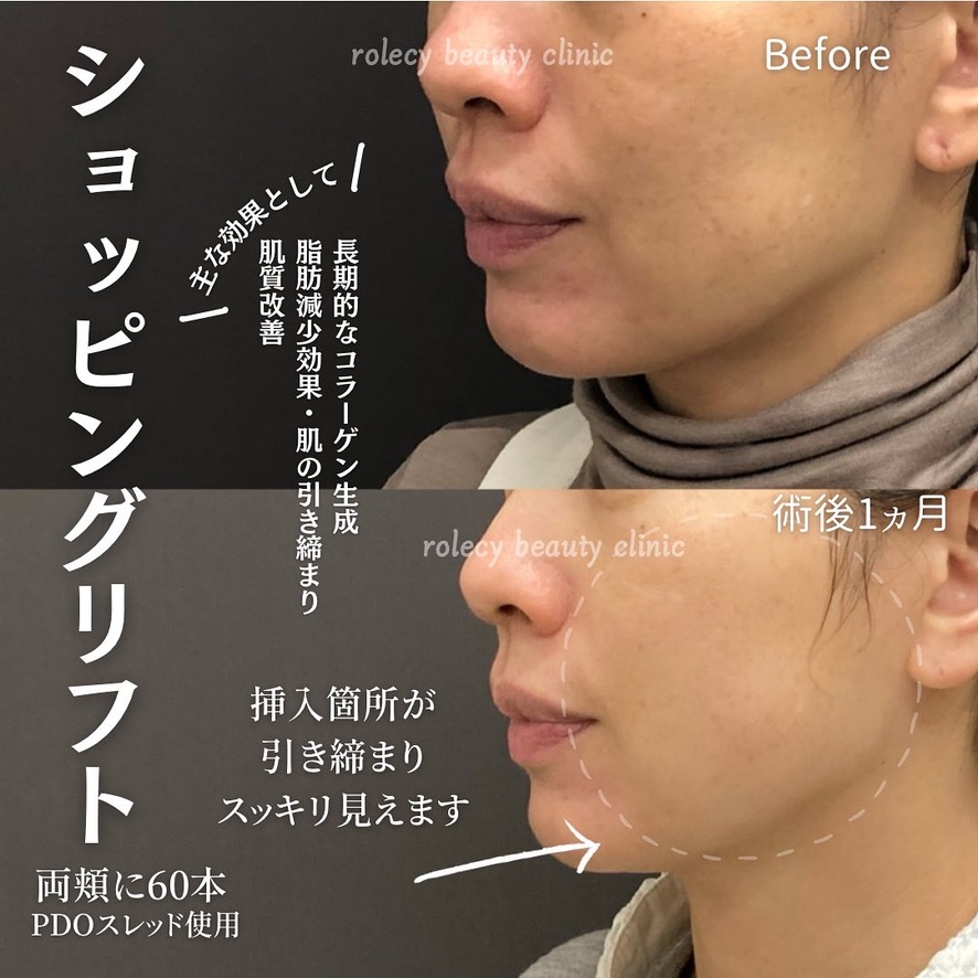 PDOショッピングリフト頬50本症例写真