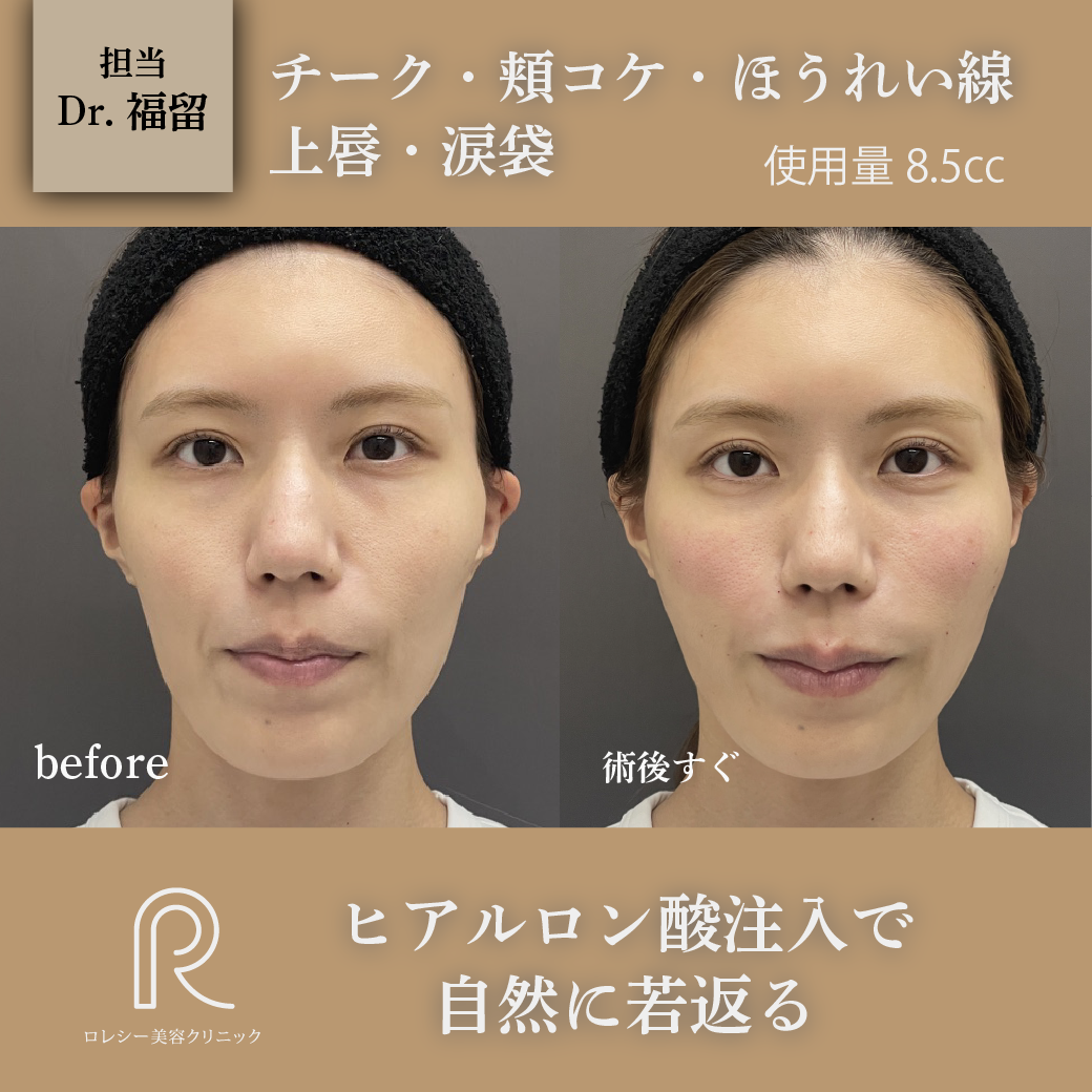 ヒアルロン酸リフト症例写真