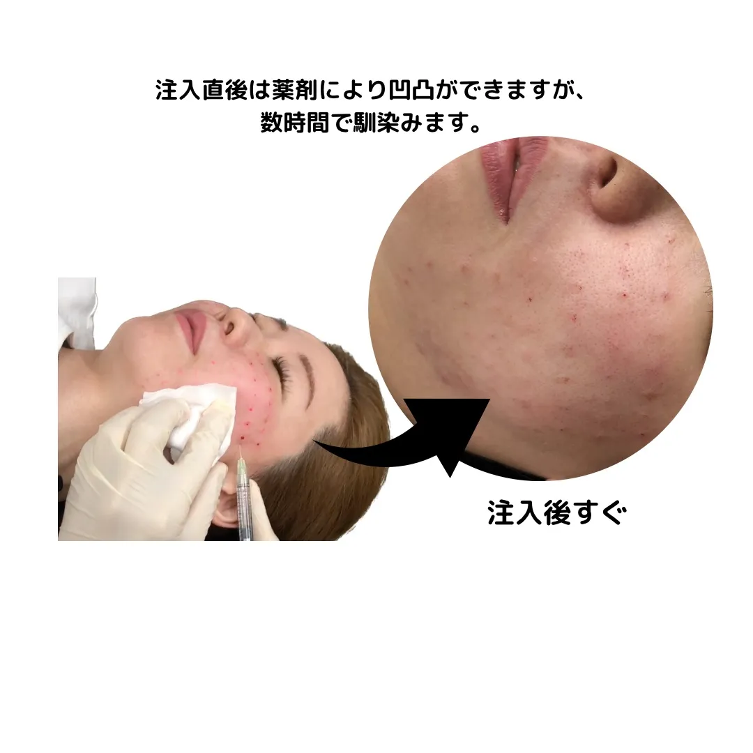 ヒアルロン酸ボライト特徴が分かるイラスト