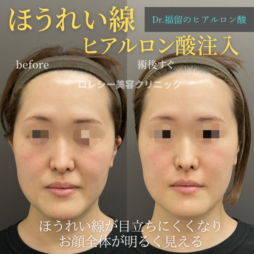 ほうれい線ヒアルロン酸の症例写真