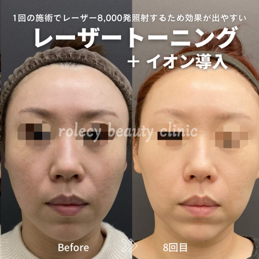 レーザートーニング5回+イオン導入5回症例写真
