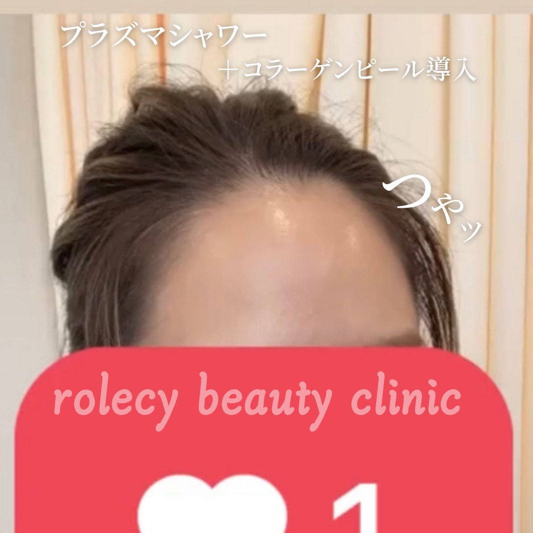 プラズマシャワー(コラーゲンピール導入)の症例写真