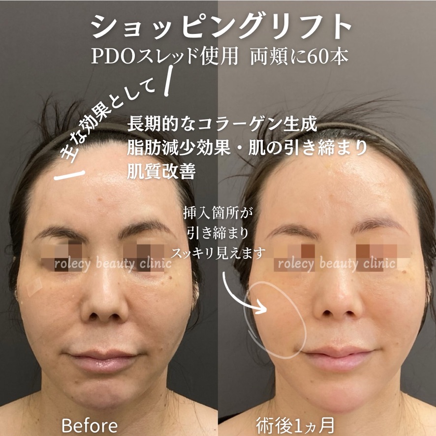 PDOショッピングリフト頬60本症例写真