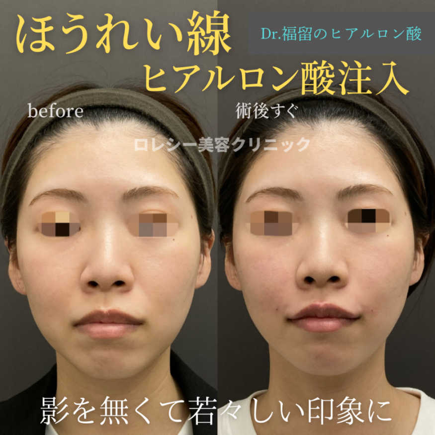 ヒアルロン酸注入ほうれい線症例写真