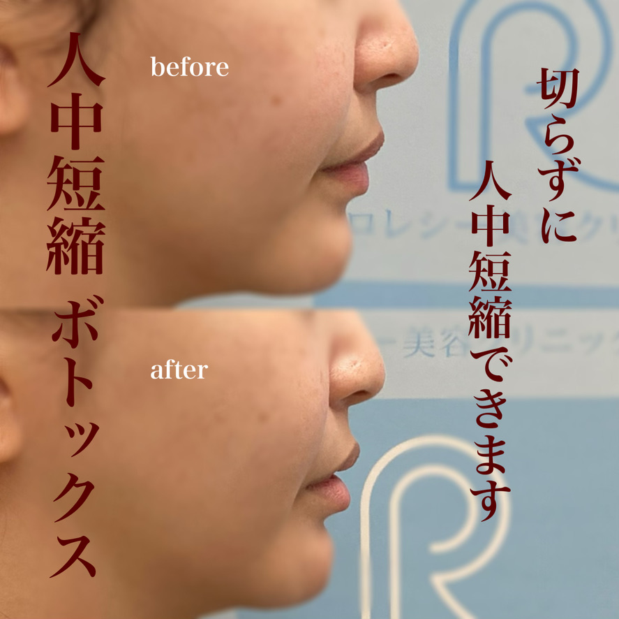 人中短縮ボツリヌス注射