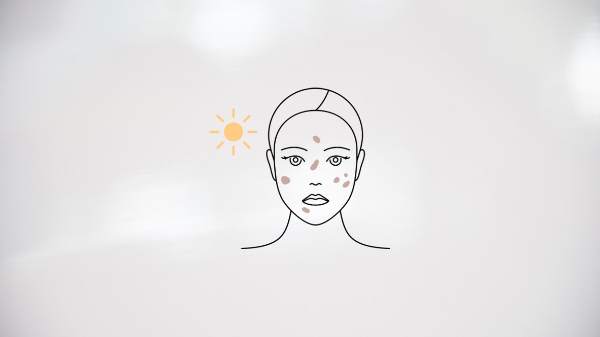 シミがある女性のイラスト