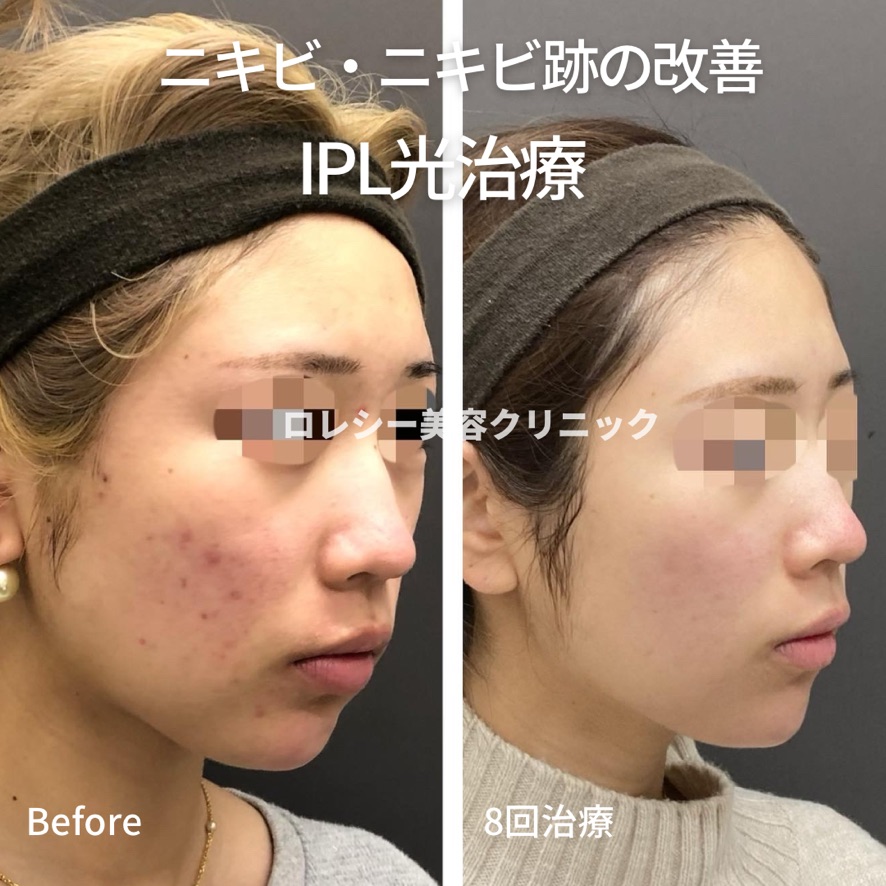 フォトフェイシャル症例写真
