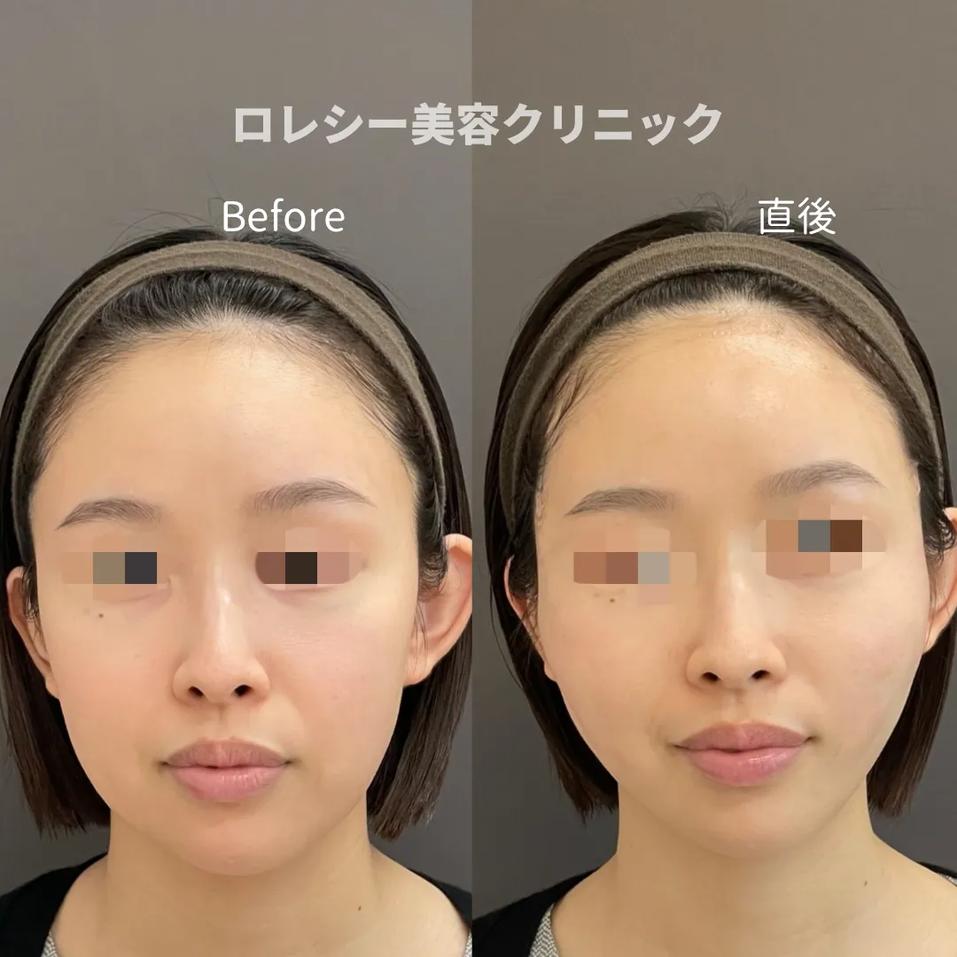 トゥインクルリフト12本症例写真