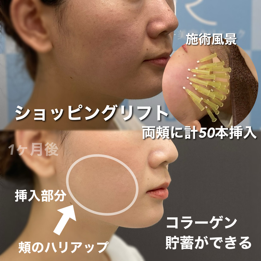 PDOショッピングリフト頬50本症例写真