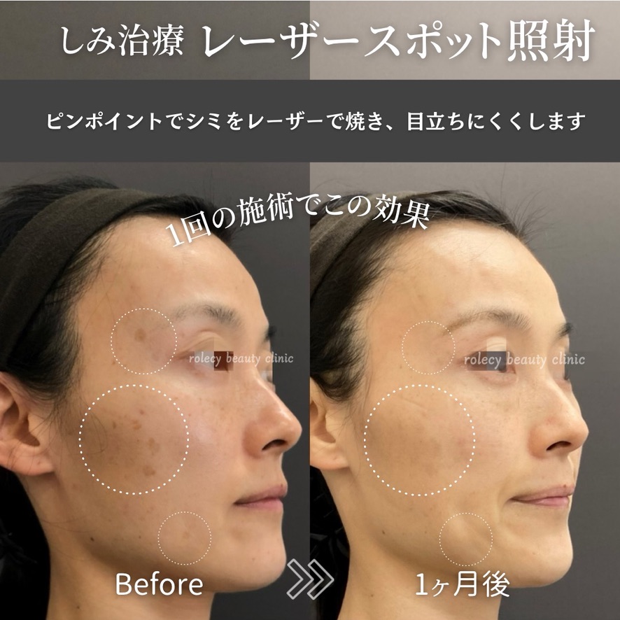 シミ取りレーザースポット照射の症例写真