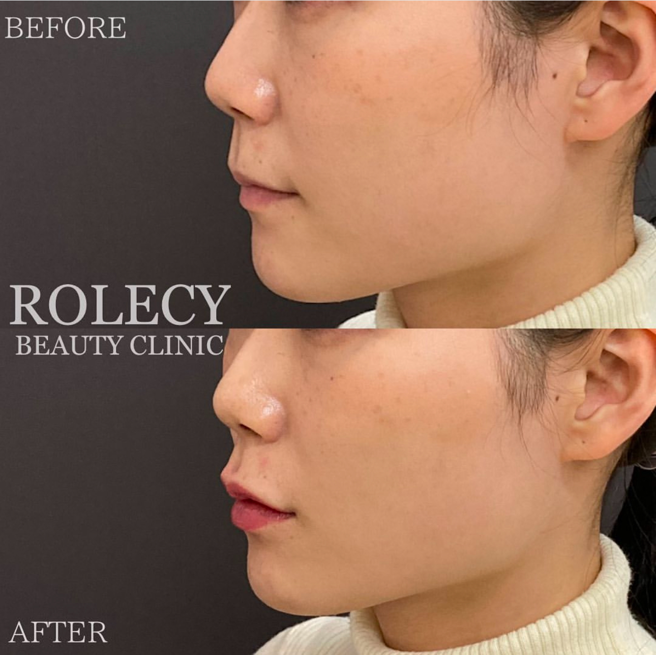 人中短縮ヒアルロン酸注入唇症例写真