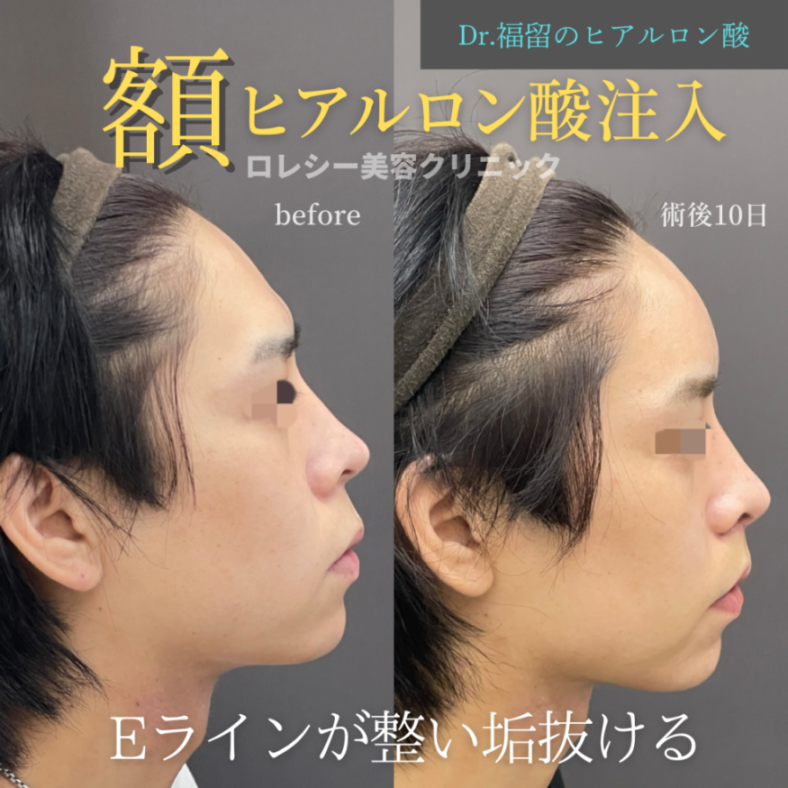 おでこヒアルロン酸注入額症例写真