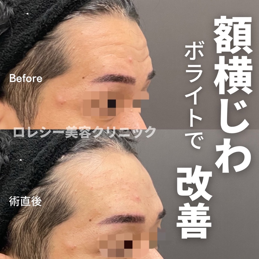 ほうれい線ヒアルロン酸注入症例写真