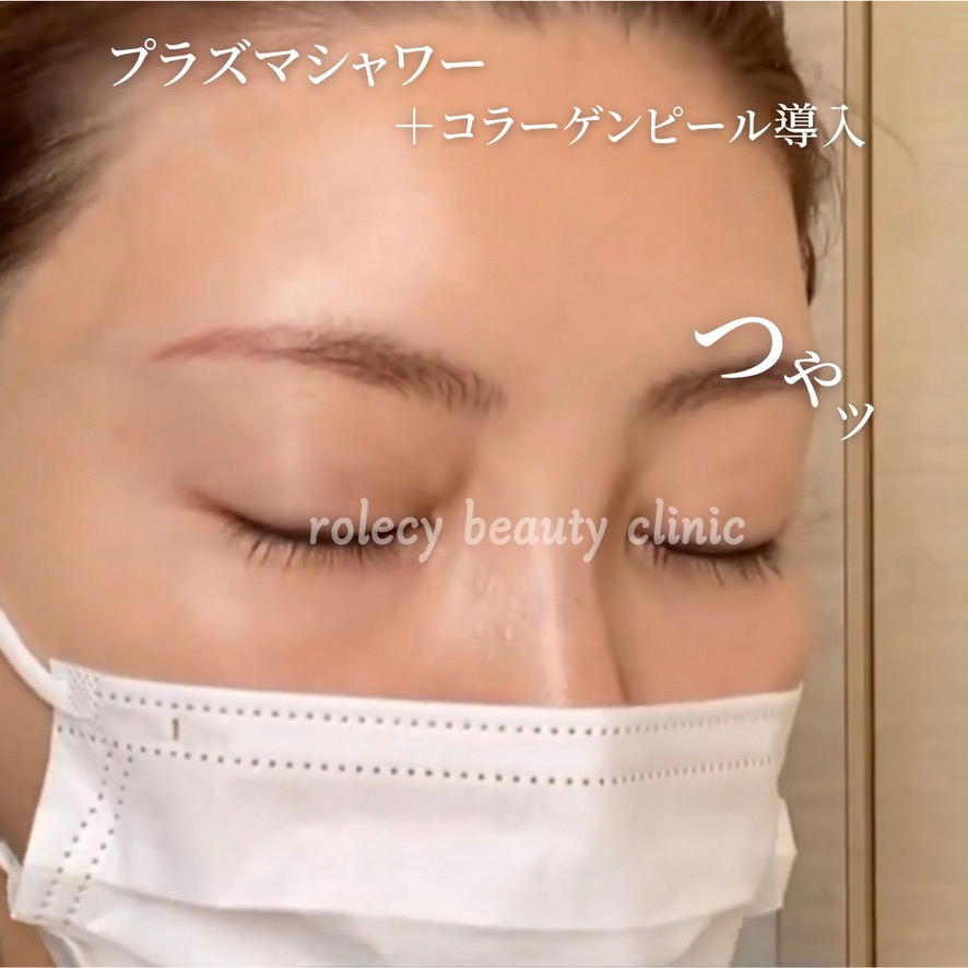 プラズマシャワー(コラーゲンピール導入)の症例写真
