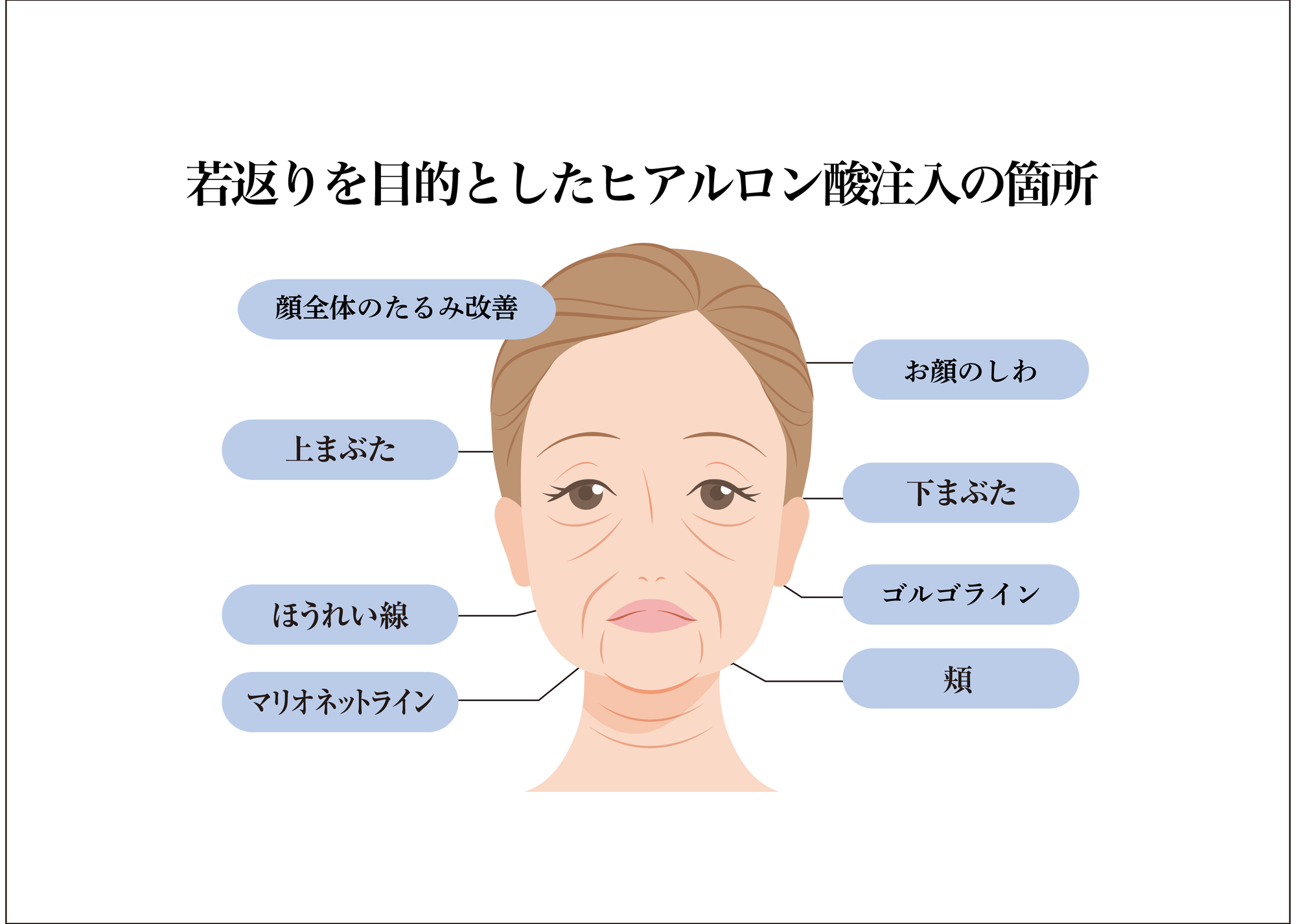 若返り目的ヒアルロン酸注入箇所