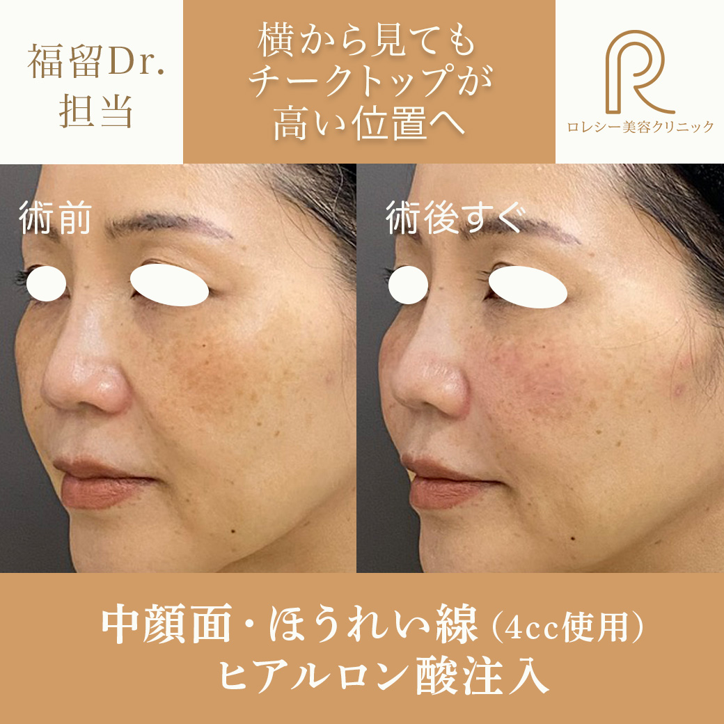 ヒアルロン酸リフト症例写真
