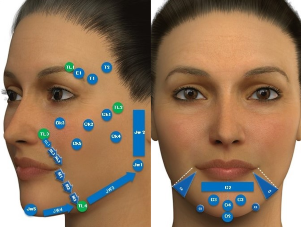 ヒアルロン酸リフトのMDコードが分かるイラスト