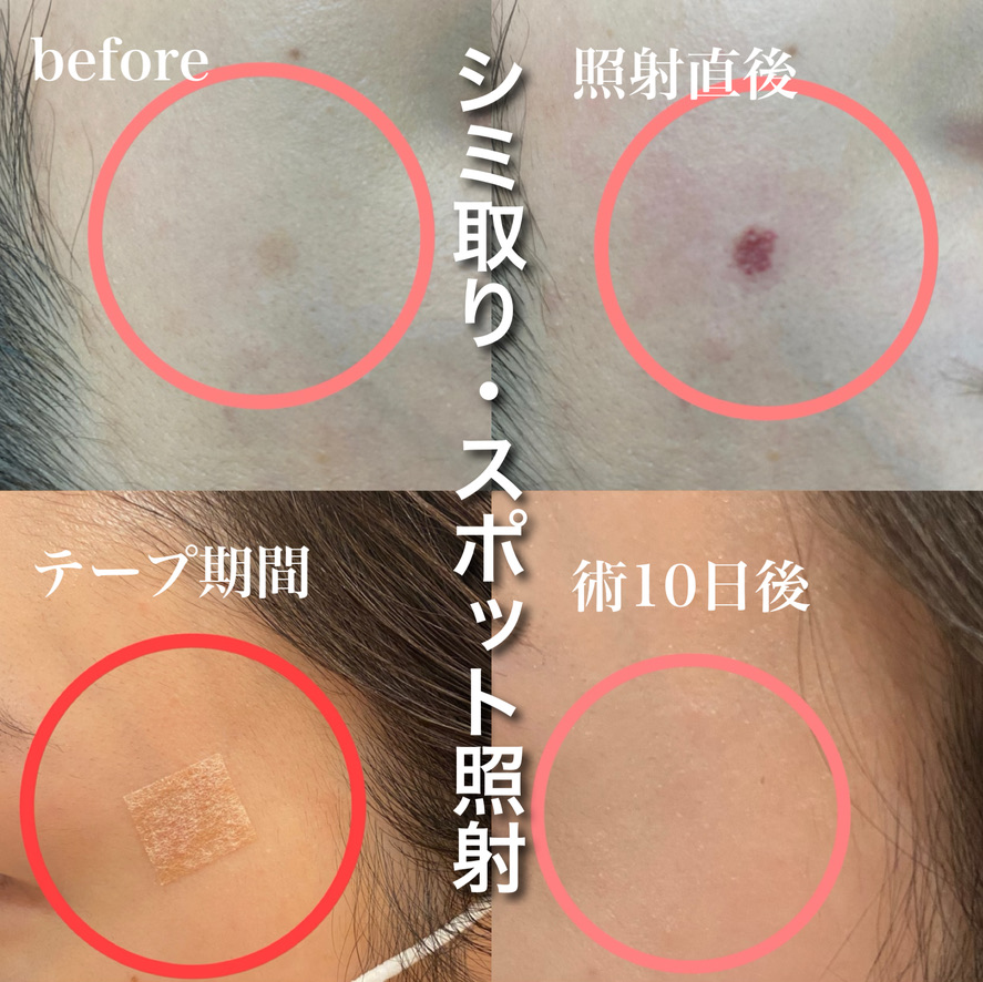 シミ取りレーザースポット照射の症例写真