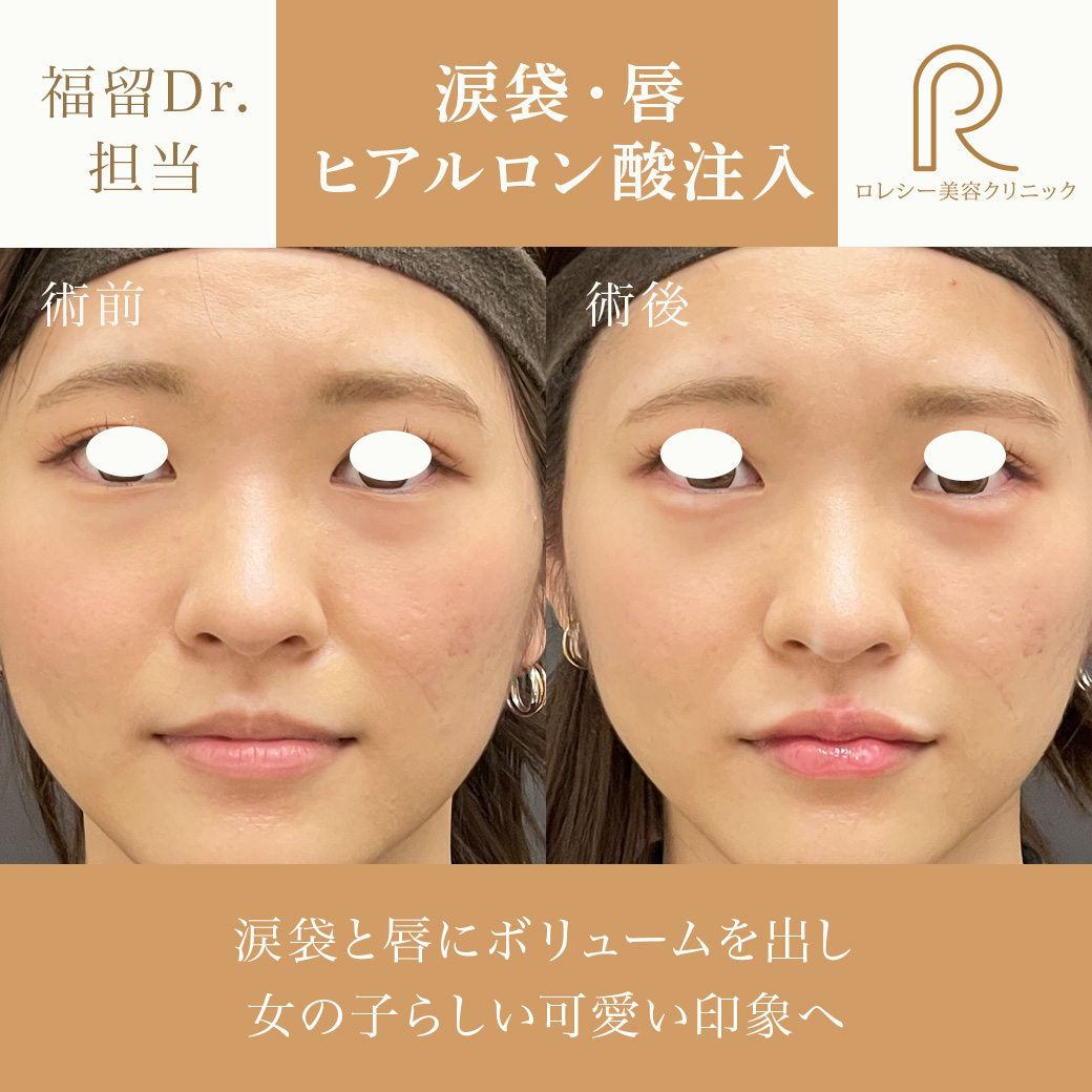 唇ヒアルロン酸涙袋ヒアルロン酸の症例写真