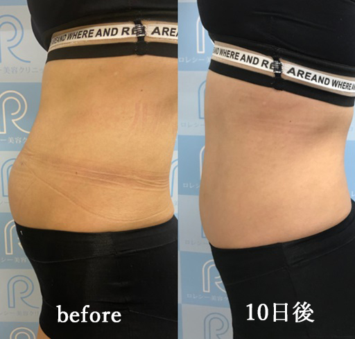 GLPー1ダイエット症例写真