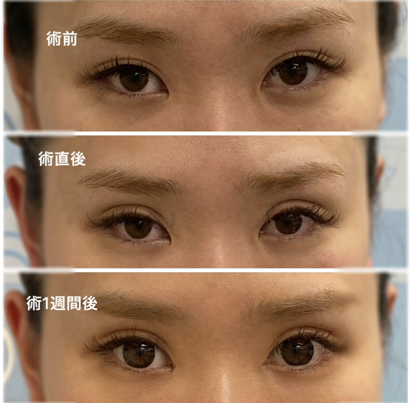 埋没二重症例写真