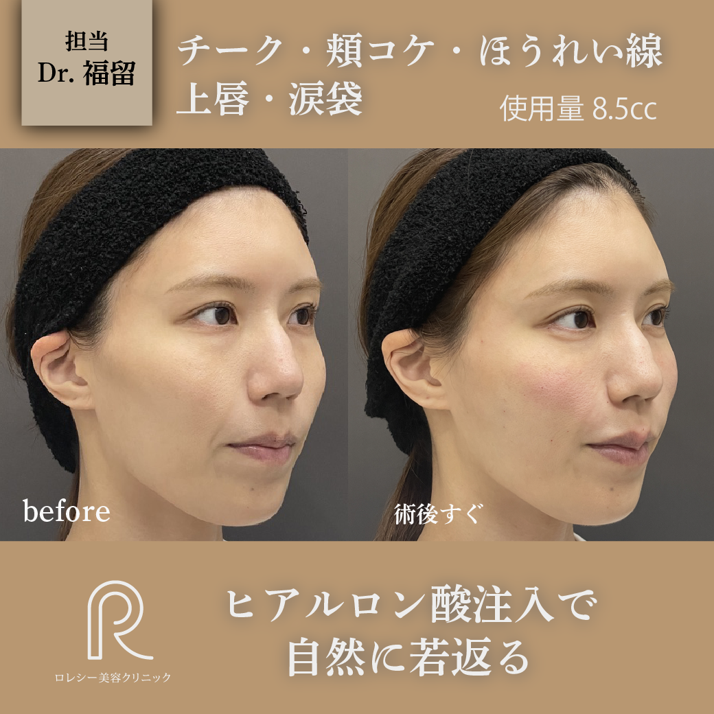 ヒアルロン酸リフト症例写真