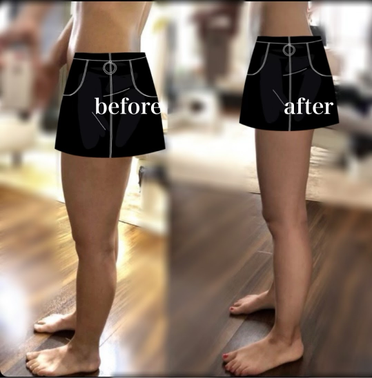 GLPー1ダイエット症例写真