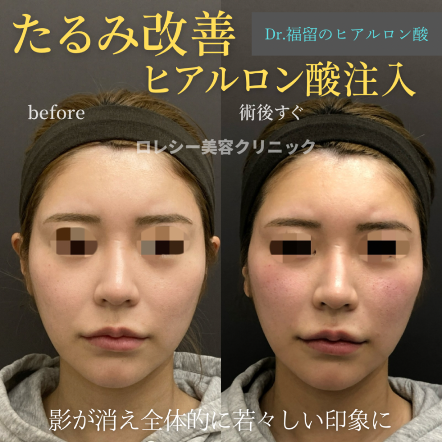 ほうれい線ヒアルロン酸写真