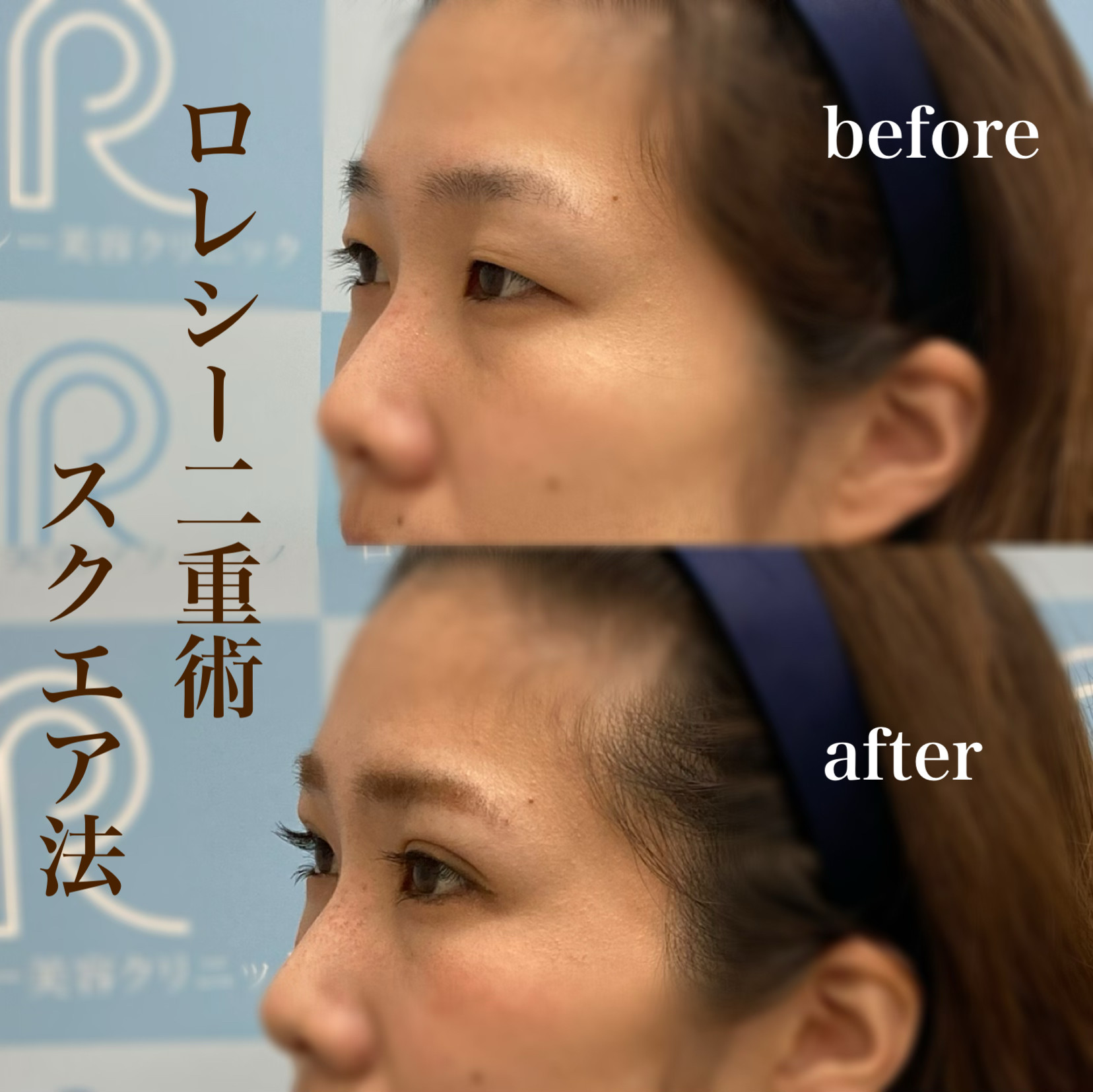 埋没二重症例写真