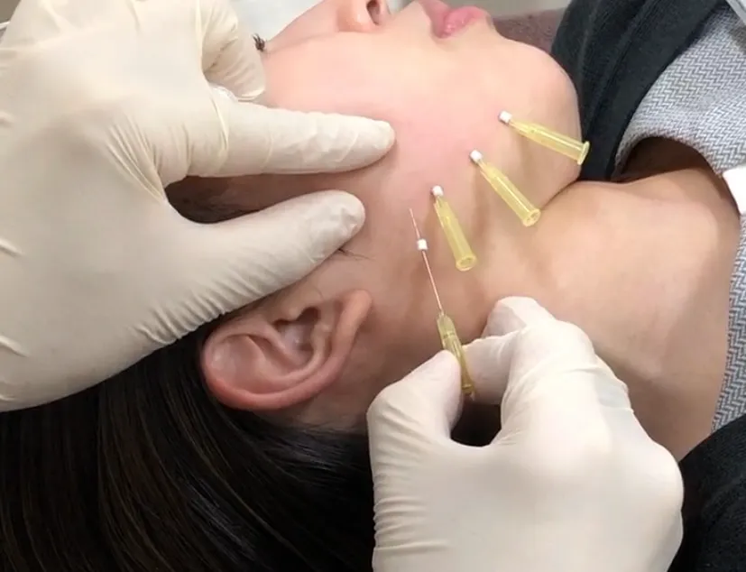 ショッピングリフトの施術中写真