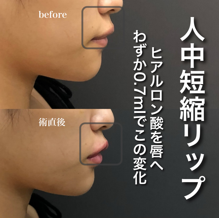 人中短縮リップ