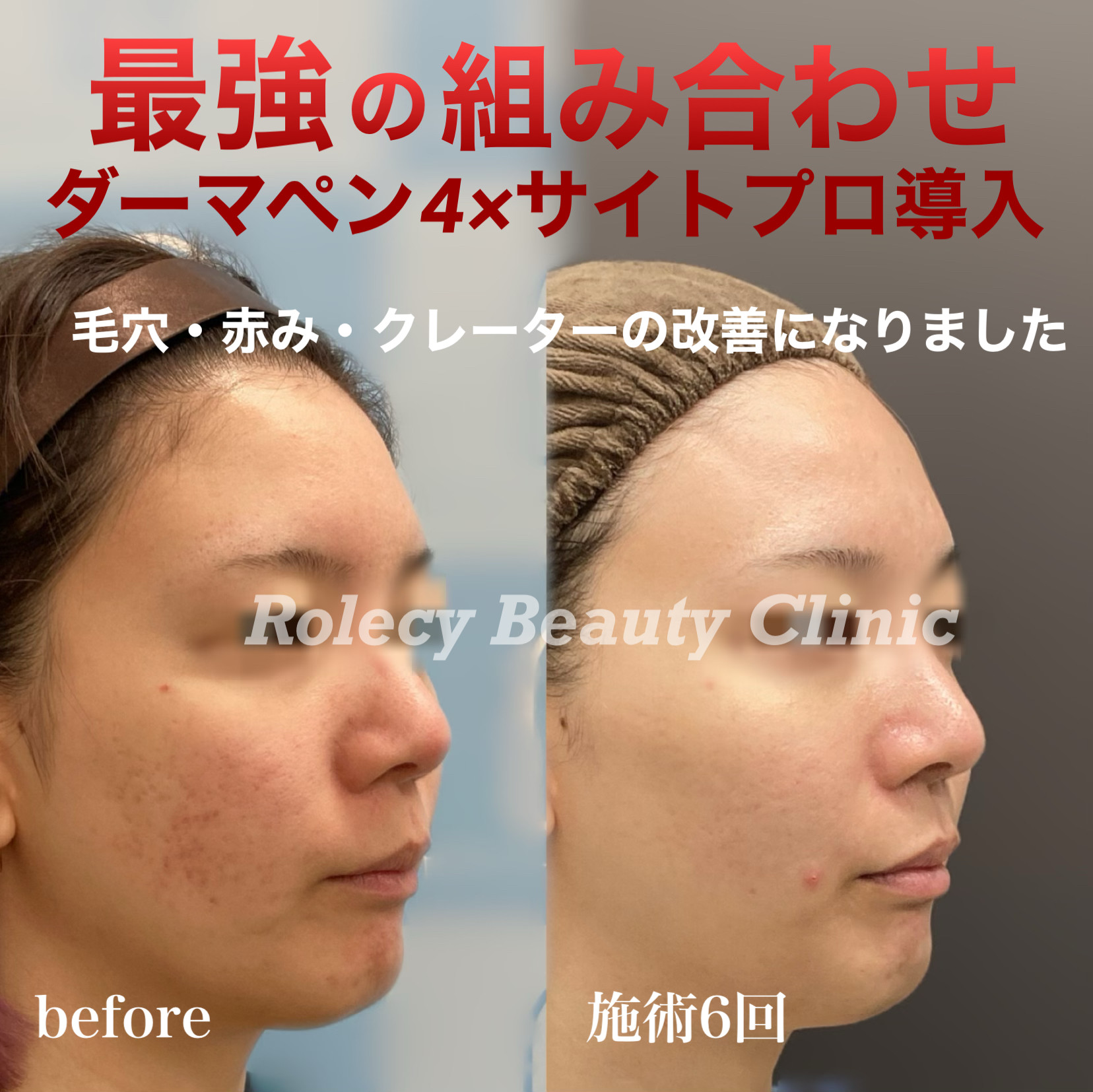 ヴェルベットスキン 症例写真