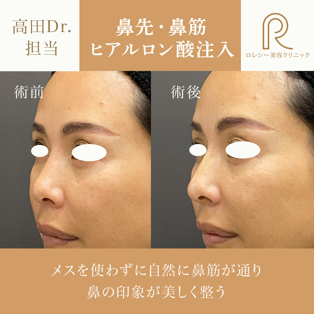 鼻先ヒアルロン酸 鼻筋ヒアルロン酸症例写真