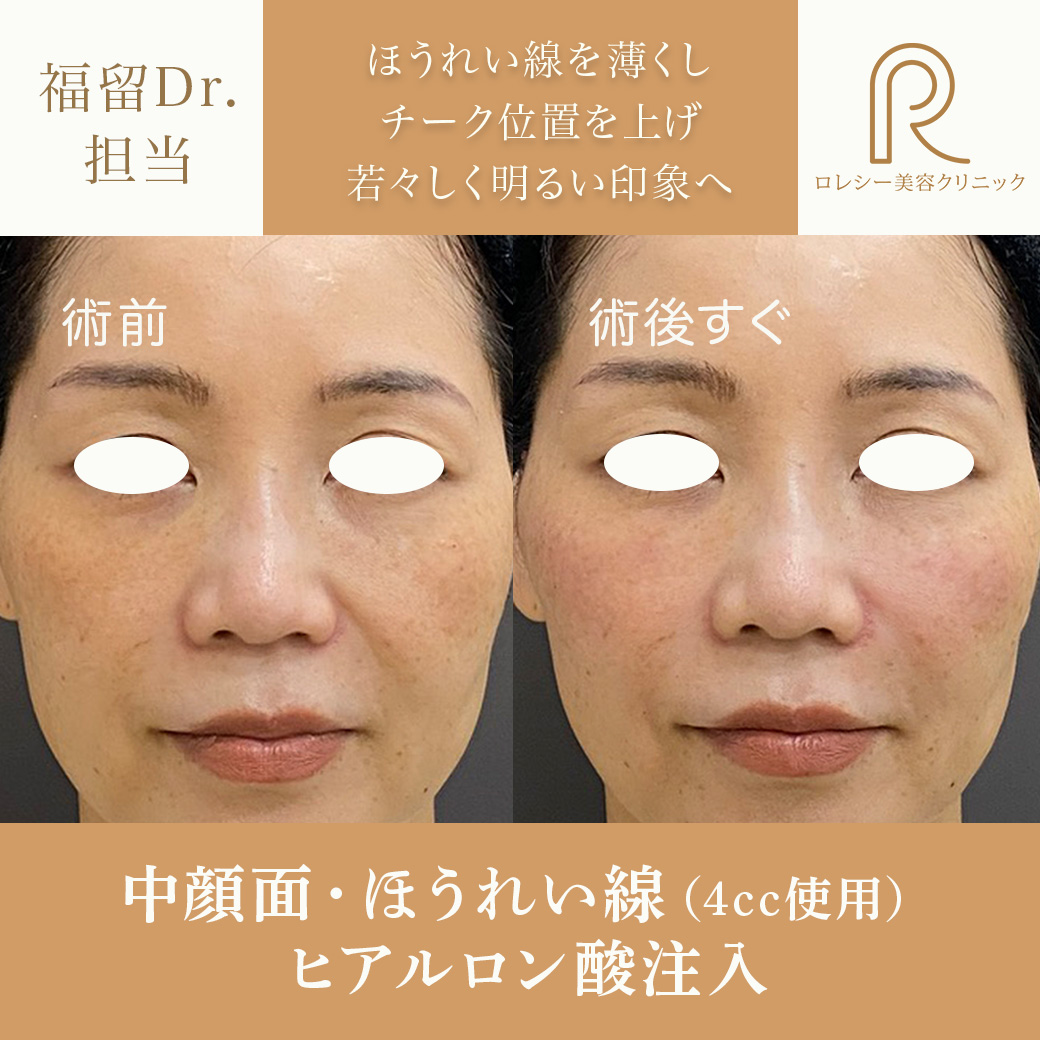 ヒアルロン酸リフト症例写真