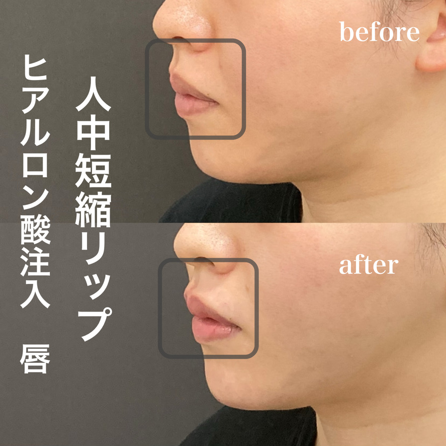人中短縮リップ