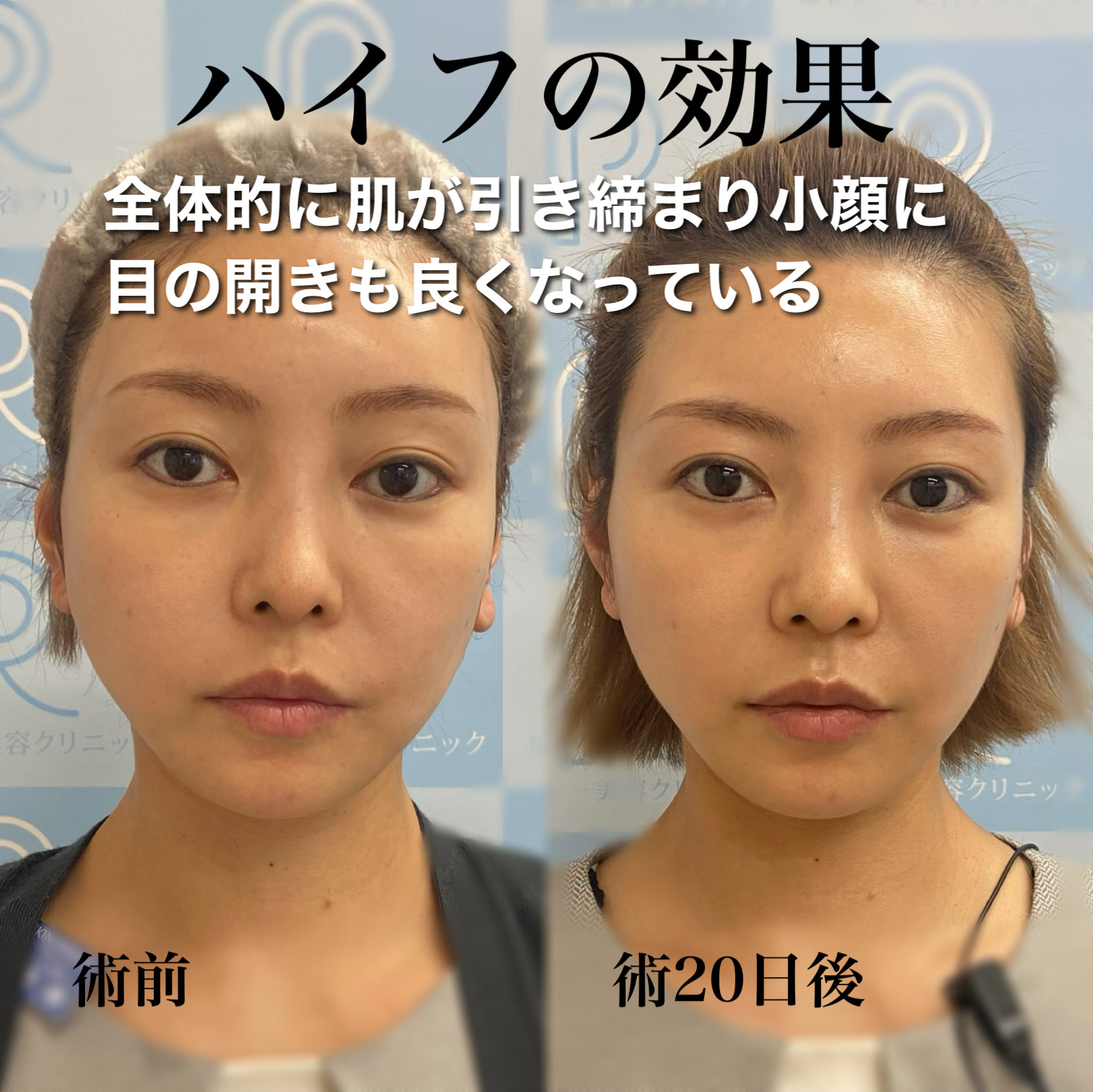 HIFU全顔フル+顎下中央症例写真