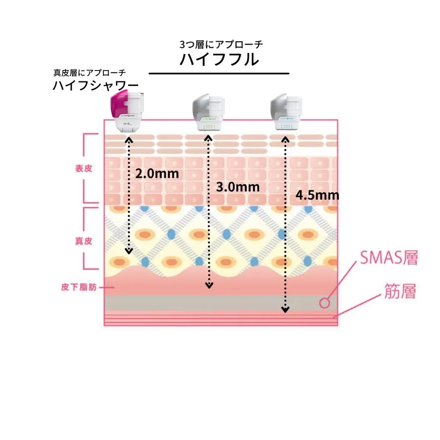 カートリッジの種類別でアプローチする場所が分かる肌断面のイラスト