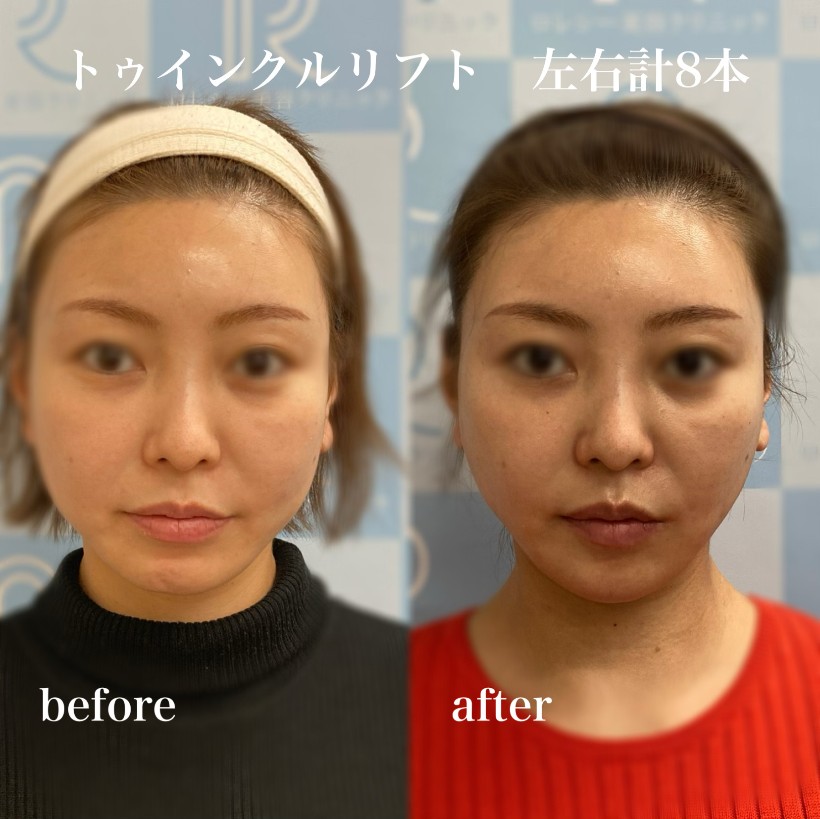 トゥインクルリフト8本症例写真