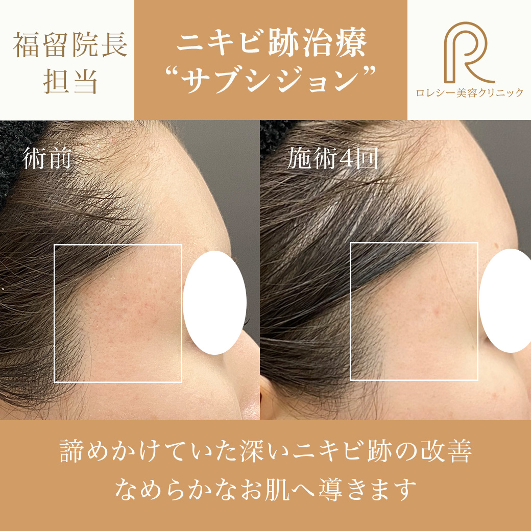 サブシジョン症例写真