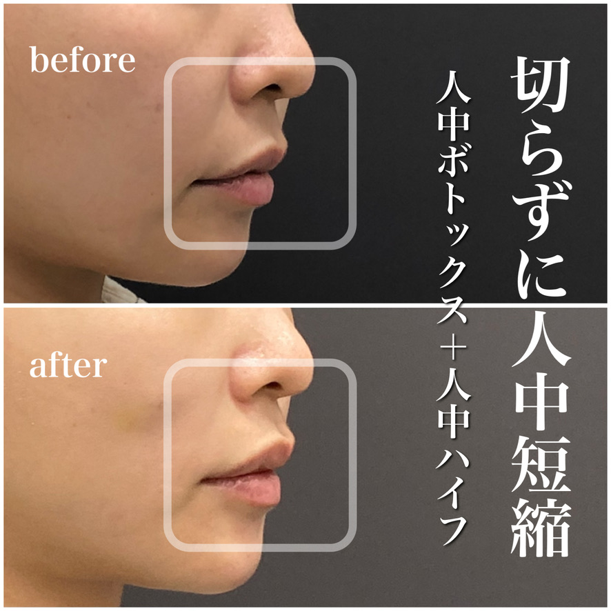 人中短縮ボツリヌス注射+ハイフ+ヒアルロン酸注入(リップ)