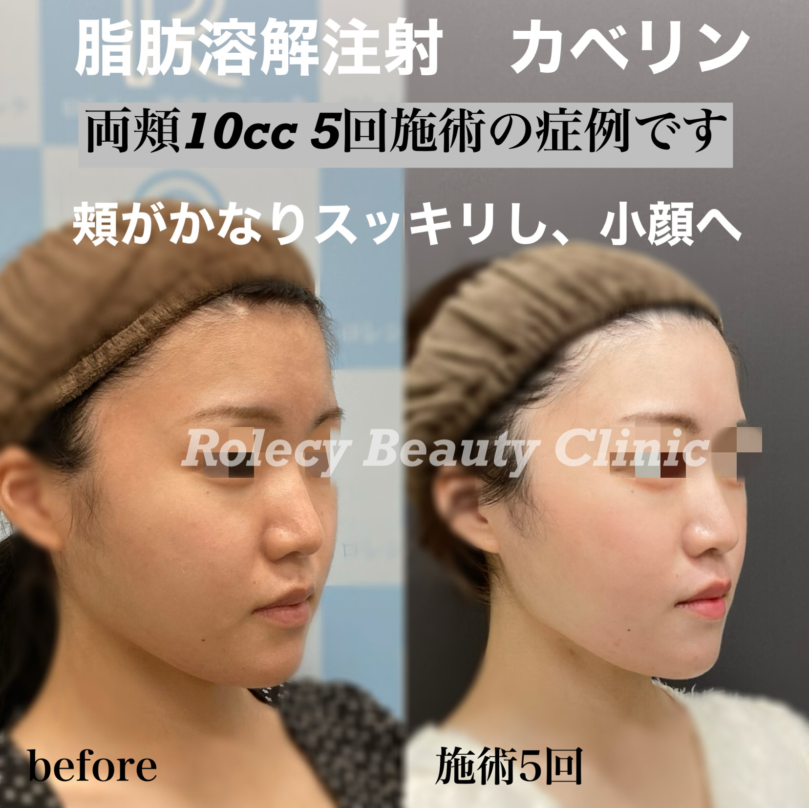 カベリン両頬10cc 5回施術症例写真