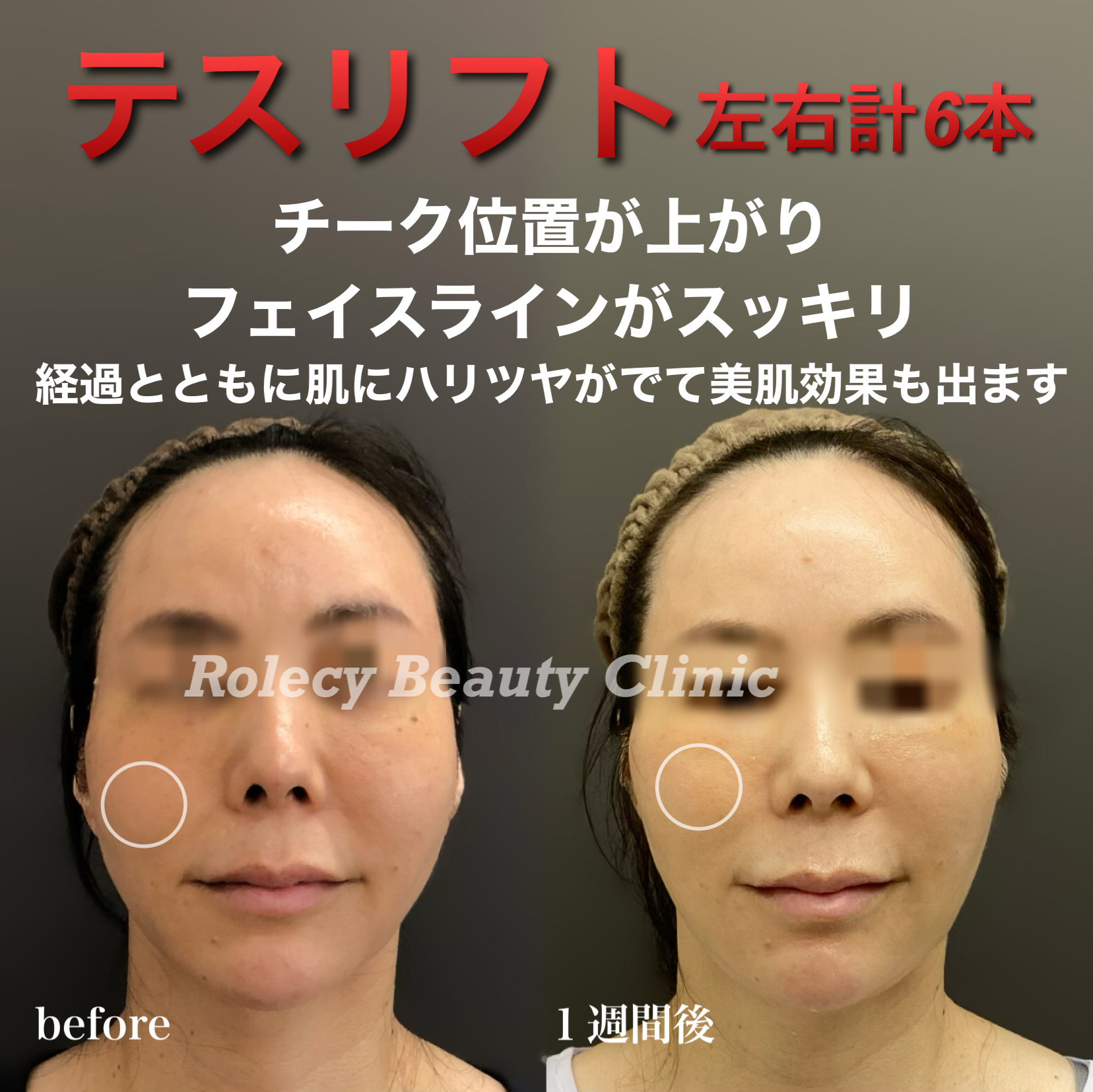 テスリフト症例写真