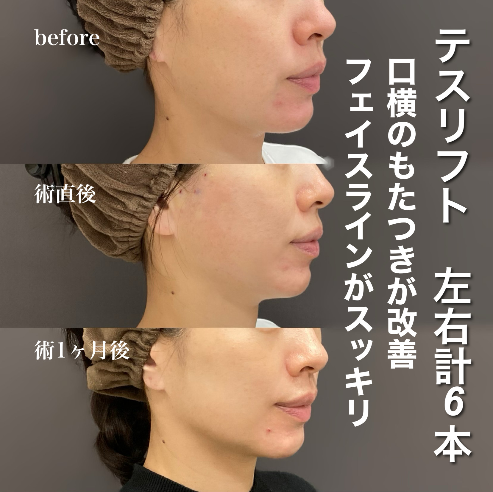 テスリフト症例写真