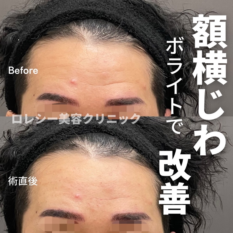 ほうれい線ヒアルロン酸注入症例写真