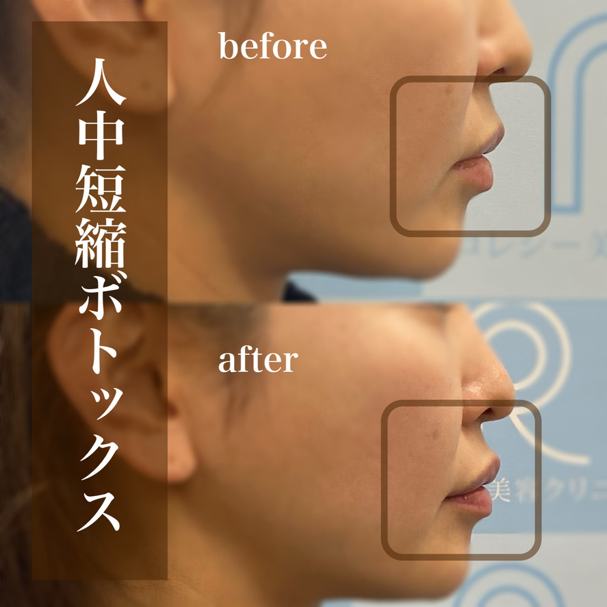 人中短縮ボツリヌス注射