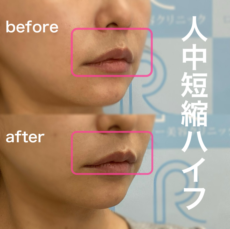 人中短縮ハイフ