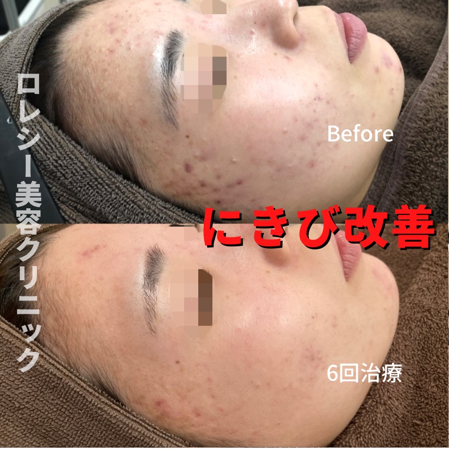 ダーマペン4症例写真