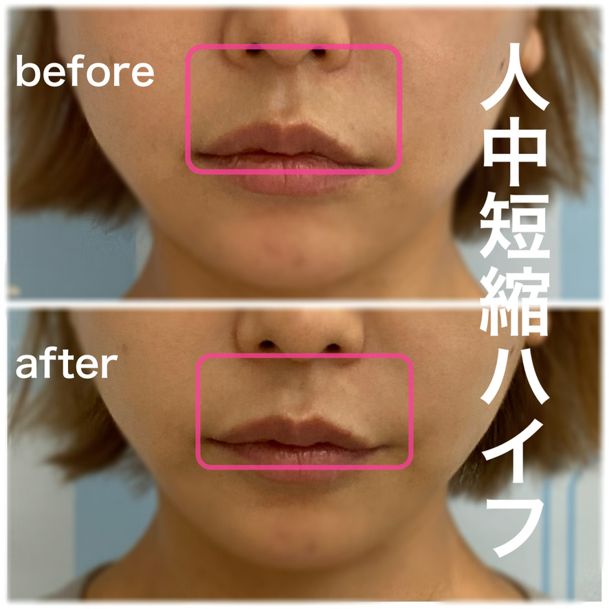 人中短縮ハイフ